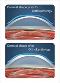 orthokeratology-ok